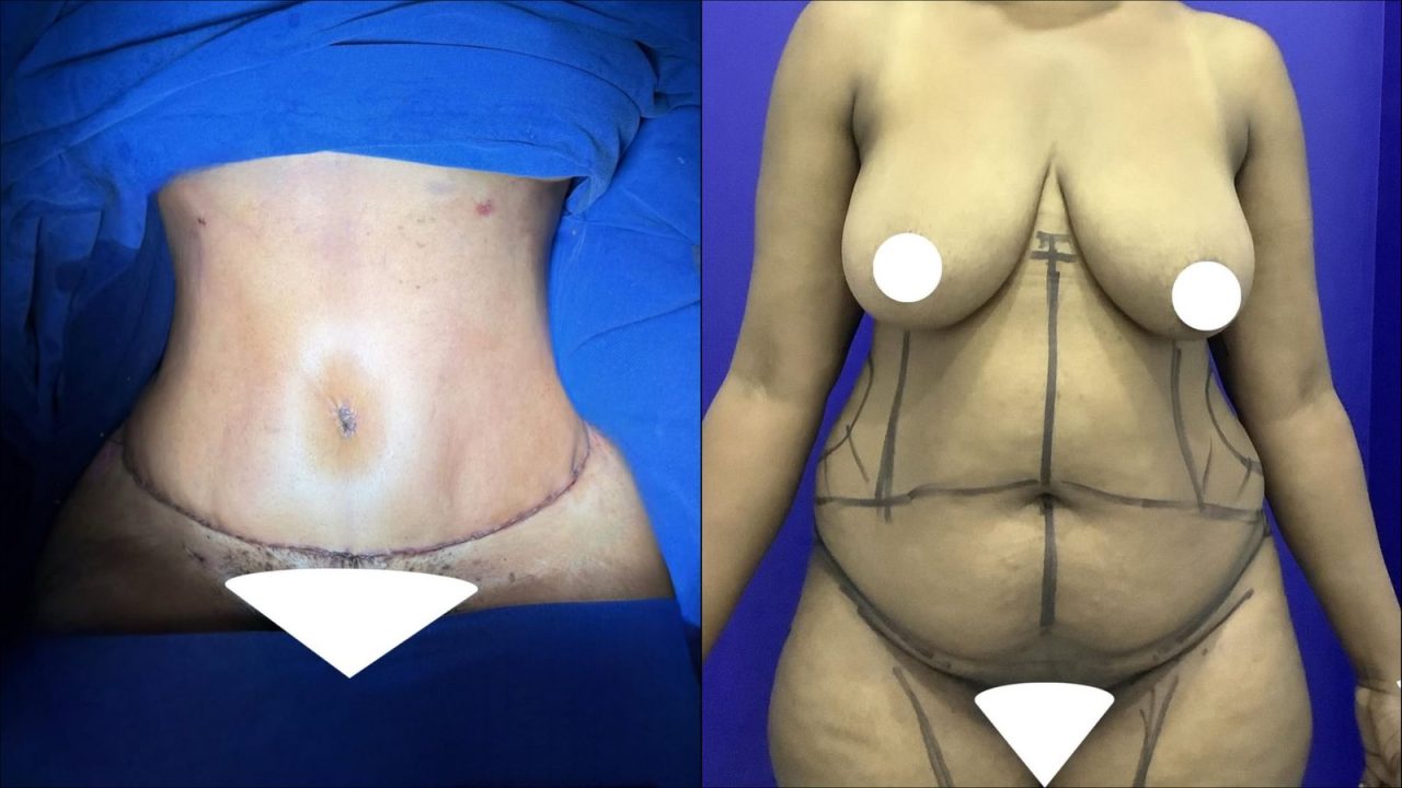 abdominoplatia-latinsurgery abdominoplatia-latinsurgery